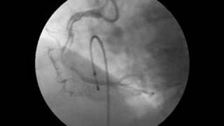 Spiral dissection of Right Coronary Artery [upl. by Ben]