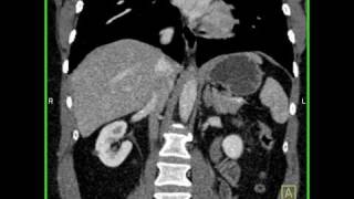 Abdomen Liver Hemangioma of the Liver6 of 8 [upl. by Peirsen]