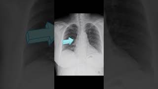 Fusiform aneurysmal dilatation of ascending aorta [upl. by Cameron]