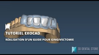 EXOCAD Tutoriel  Comment réaliser des gouttières de gingivectomie via Exocad 3D Dental Store [upl. by Ydnamron]