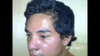 Nose Lift and alar trimming Philippines [upl. by Roach]