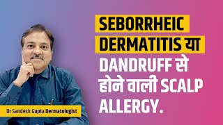 Seborrheic dermatitis या Dandruff से होने वाली scalp allergy Dr sandesh Gupta 9990804085 [upl. by Artinad]