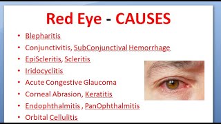 Ophthalmology 167 Acute Red Eye Differential Diagnosis causes Conjunctivitis Uveitis Glaucoma [upl. by Isawk]