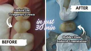 Emax Crown Cementation with Rubber Dam  StepbyStep Removal of LockedOn Temporary Crown [upl. by Elleynod]