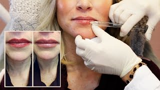 30 Units of Botox  Lip Filler from Doctor Cynthia Cote [upl. by Nidnarb82]