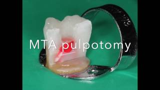 MTA pulpotomy step by step by Jorge Casián Adem [upl. by Ardnosak]