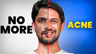 Get rid of PIMPLE amp ACNE Naturally  Real Causes amp Effective Solutions  Saurabh Bothra [upl. by Harwell]