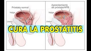 ELIMINA LA PRÓSTATA INFLAMADA O LA PROSTATITIS DE FORMA RÁPIDA Y FÁCIL ALIVIA EL DOLOR Y ARDOR [upl. by Ahtelat]