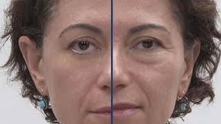 Get rid of wrinkles without injections using Plexaderm for only 1495 [upl. by Toogood]