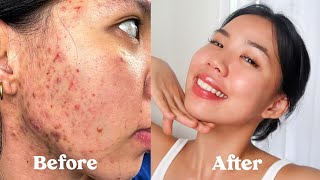 ENG SUB HOW I GOT RID OF MY ACNE SCARS TEXTURE amp HYPERPIGMENTATION not sponsored [upl. by Adia366]