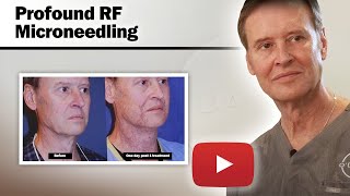 Profound RF Microneedling  Case Studies And Results [upl. by Hakon]