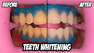 Teeth Whitening Process  BEFORE and AFTER  BLEACHING [upl. by Shedd566]