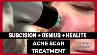 Rolling Acne Scars treated with Cannula Subcision NEW Genius and Healite [upl. by Barrie562]