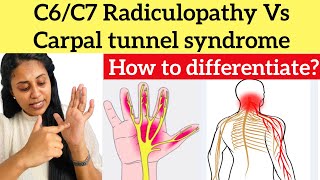 C6C7 Radiculopathy Vs Carpal tunnel syndrome carpaltunnelsyndrome cervicalpain radiculopathy [upl. by Normie564]