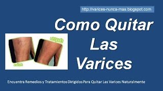 Como Se Quitan Las Varices [upl. by Eisaj958]