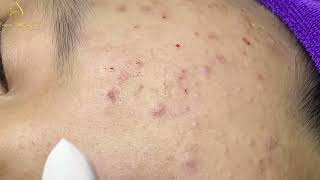 Loan Nguyen Acne Treatment 0099 [upl. by Ablem]