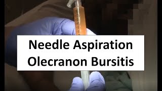 Needle Aspiration of Olecranon Bursitis [upl. by Whitten597]