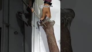 Distal Radius Fracture Kwire Removal Procedure  वायर निकालने की प्रोसीजर  Dr Prateek Joshi ortho [upl. by Tenneb]