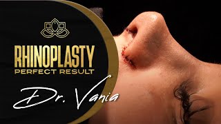 Dr Vania delivers perfect Rhinoplasty ✨ Rhinoplasty in Mexico at Vive Plastic Surgery 🙌 [upl. by Zeeba]