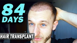 FUE Hair Transplant Day 84 post op Istanbul Turkey GROWTH STAGE [upl. by Otsedom]