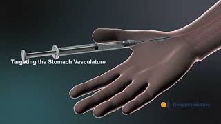 Bariatric Arterial Embolization BAE with Dr Arash Padidar A Revolutionary WeightLoss Procedure [upl. by Eelorac]