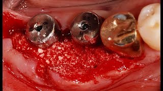 Transmucosal GBR using collagenated bone graft material  Dr Han Seung Min [upl. by Airotkciv233]