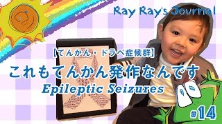 14 【てんかん・ドラべ症候群】これもてんかん発作なんですEpileptic Seizures English subs [upl. by Hola]