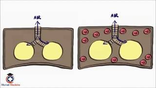 Pneumothorax and Tension Pneumothorax [upl. by Dobrinsky205]