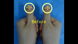 Clubbed thumbs correction [upl. by Arrat404]