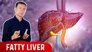 Why Does a Fatty Liver Have No Symptoms – NAFLD Non Alcoholic Fatty Liver Disease by DrBerg [upl. by Slohcin]