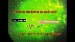 Auramine phenol stain Mycobacterium positveFluorescence microscope [upl. by Hailat]