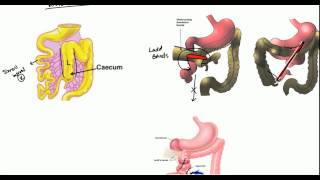 Gut Malrotation Nonrotation and Volvulus for USMLE [upl. by Ajidahk]