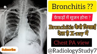 Bronchitis 🫁  Inflammation of broncus or bronchi  Chest PA view radiology xray education [upl. by Abner]