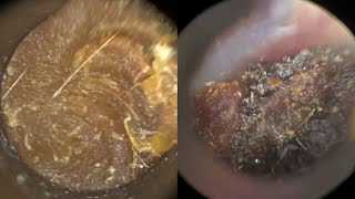 169  Ear Wax Removal in Young Child with Narrow Ears including off the Eardrum using the WAXscope®️ [upl. by Ikkim315]