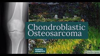 Chondroblastic osteosarcoma [upl. by Birgitta]