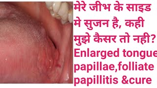 मेरे जीभ के साइड मे सुजन है कही मुझे कैसर तो नहीEnlarged tongue papillaefolliate papillitis ampcure [upl. by Letnahc]