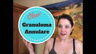 How my Granuloma Annulare Cleared Up [upl. by Seward243]