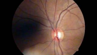 Optic Disc  Spontaneous Venous Pulsations [upl. by Philomena878]