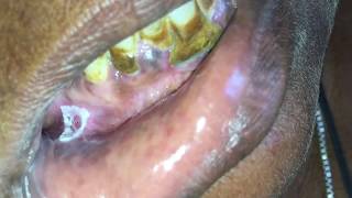 LeukoplakiaSmokers Keratosis [upl. by Ryder]