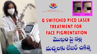 Q Switched Pico Laser treatment for Face Pigmentation [upl. by Idleman]