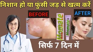 momate cream use in hindi mometasone cream [upl. by Nnylyt]