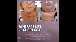 OB Čukić Esthetics  Dr Tamara Petrović – Mini Facelift vs Short Scar Facelift [upl. by Goodill]