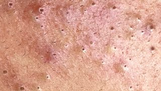 Big Cystic Acne Blackheads Extraction Blackheads amp Milia Whiteheads Removal Pimple Popping 0037💆 [upl. by Conner]