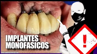 La REALIDAD de los IMPLANTES MONOFÁSICOS [upl. by Noramac320]