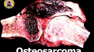 Osteosarcoma  Tumor de Hueso [upl. by Akimat51]