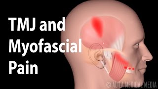 TMJ and Myofascial Pain Syndrome Animation [upl. by Oicnoel]