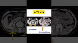 Left Kidney Absent [upl. by Klayman572]