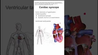 Cardiac syncope [upl. by Thrasher]