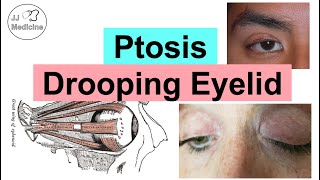 Ptosis Drooping Eyelid  Eye Anatomy Causes Associated Conditions Diagnosis amp Treatment [upl. by Norda]