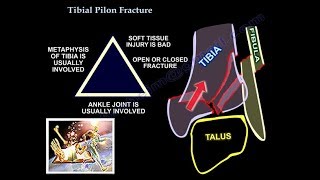 Tibial Pilon Fracture  Everything You Need To Know  Dr Nabil Ebraheim [upl. by Aihcats624]